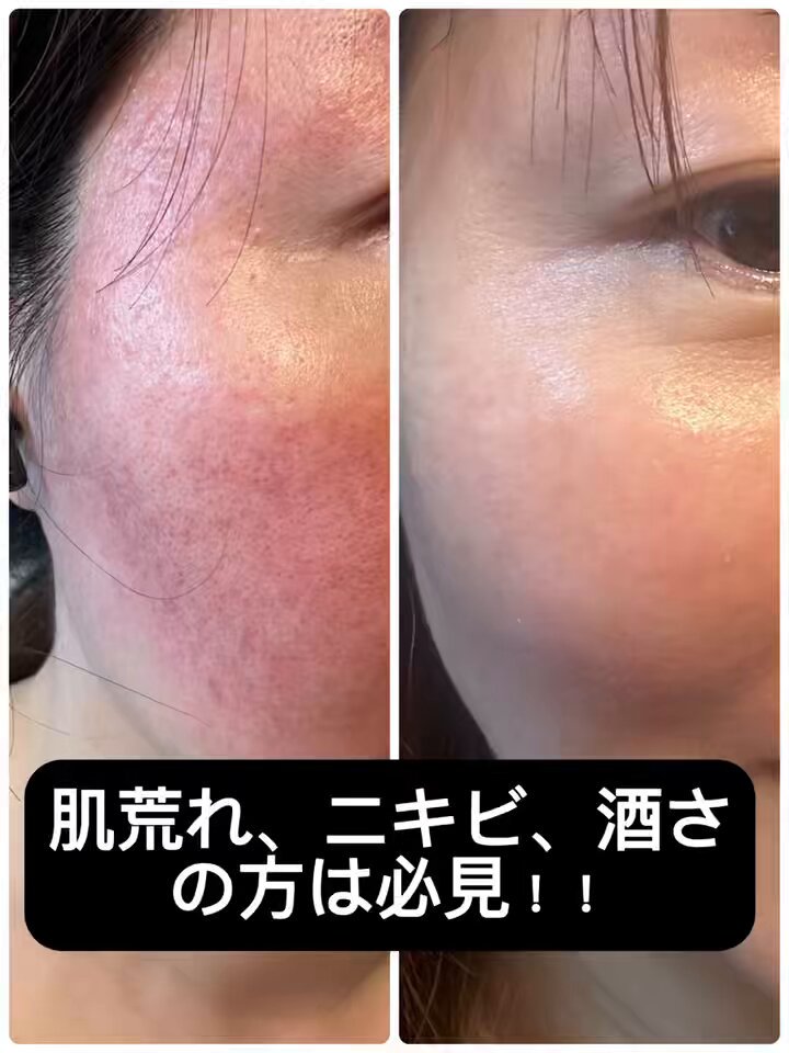 プラズマペン　繰り返すニキビ肌に　肌荒れに　業務用・セルフok プラズマペン 繰り返すニキビ肌に 肌荒れに 業務用・セルフok