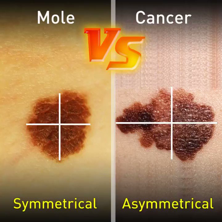 cancerous moles vs normal moles