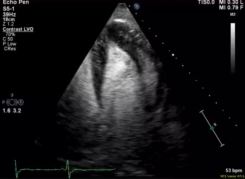 Apical HCM / Twitter