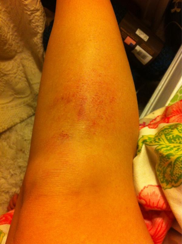 MeekMolly_Millz's tweet image. Sacrificed my leg at fhockey this morning #BeastStatus #HatersGonHate