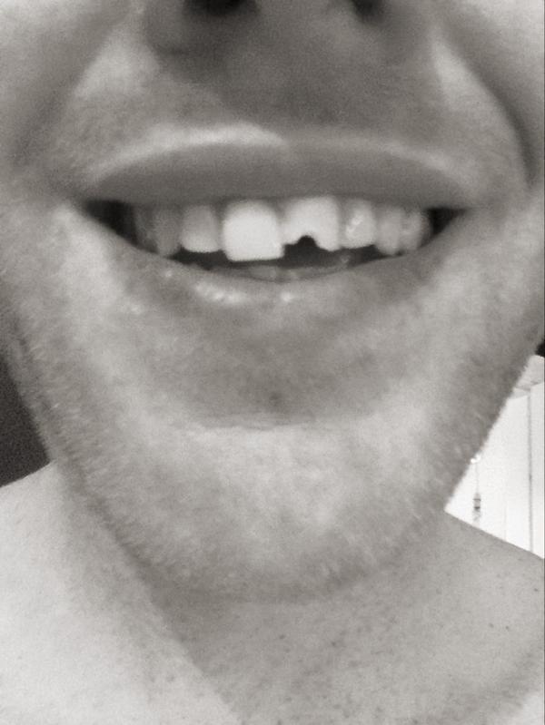 Merry Christmas my temporary filling has fallen out!! Lucky it's not my front one!!! #alliwantforxmasismyfronttooth!!