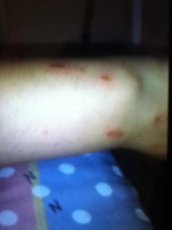 kellysuzzane's tweet image. My arm officially looks disgusting