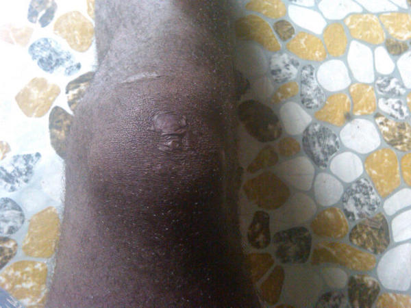 OfficialSamkayz's tweet image. My injured leg!!!!!#OOFC