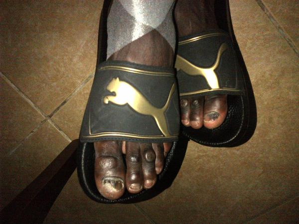Demba Ba On Twitter I Don T Know To Who This Feet Belongs But He Needs A Proper Surgery Hahahhahahahahahahahahahahahahahahahahahahahahahaha Http T Co M3vrcxjp