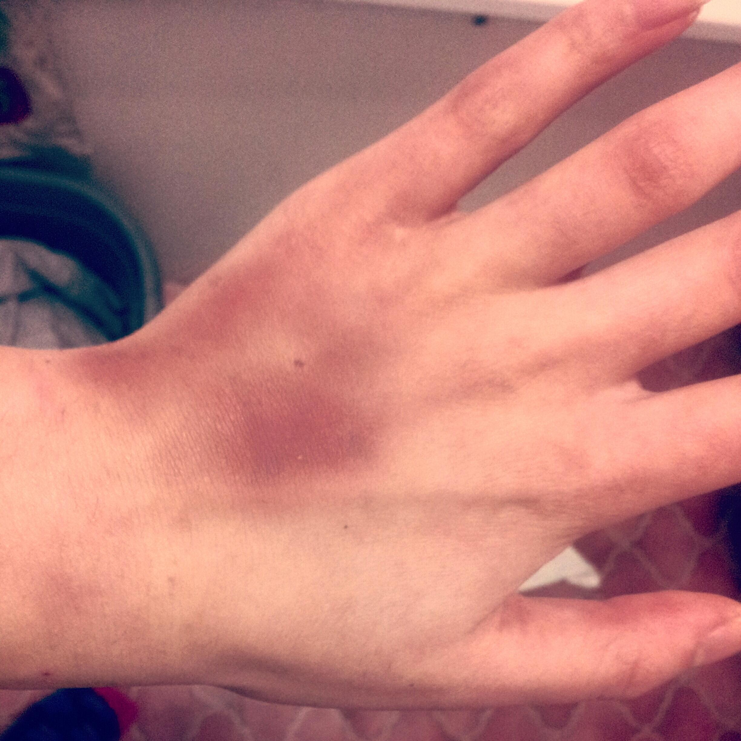 IV bruise? - January 2016 Babies | Forums | What to Expect