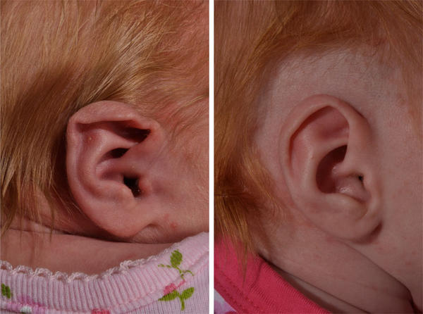 PedPlastic's tweet image. Photo: Before &amp;amp; After a Stahl's ear treated with The EarWell infant ear correction system. No surgery needed