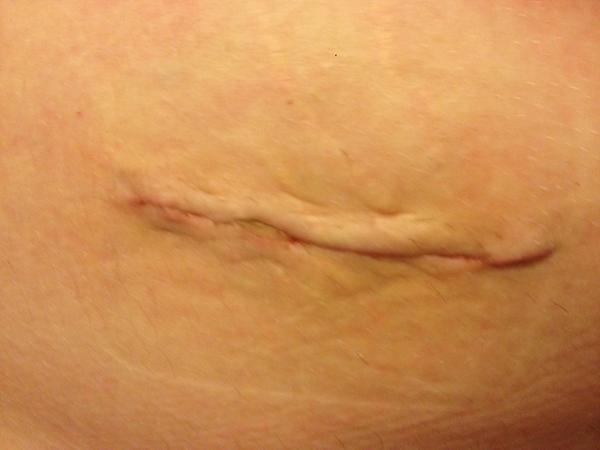 Patmcgaz's tweet photo. Chicks dig scars #gonnabealong3weeks #storyofmylife http://t.co/VYf1KtoX