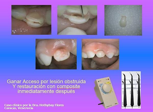 ColteneVe's tweet photo. Publica tu caso clìnico con nosotros!Este es de la Dra. Hothybay Flores con el Perfect TCSII http://t.co/ivGlYT3s