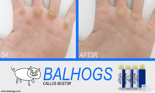 Balhogs's tweet image. Balhogs Callus Bust3r: for all your callus management needs. balhogs.bigcartel.com/product/callus…