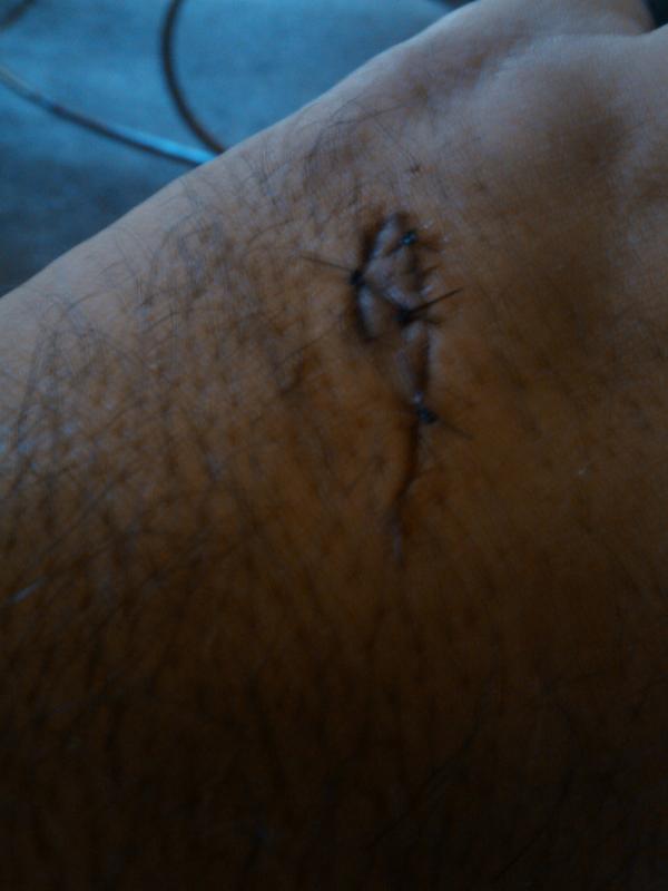 gypsygoodfella's tweet photo. No icut my hand 9 stiches lol http://t.co/7KqaXLke