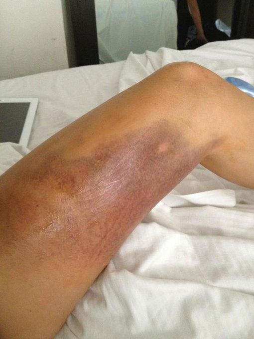 I cannot sleep , my leg still hurts :( http://t.co/A4zTIaTG<a href="/tag/fan"class="tags"><span>#fan</span></a>