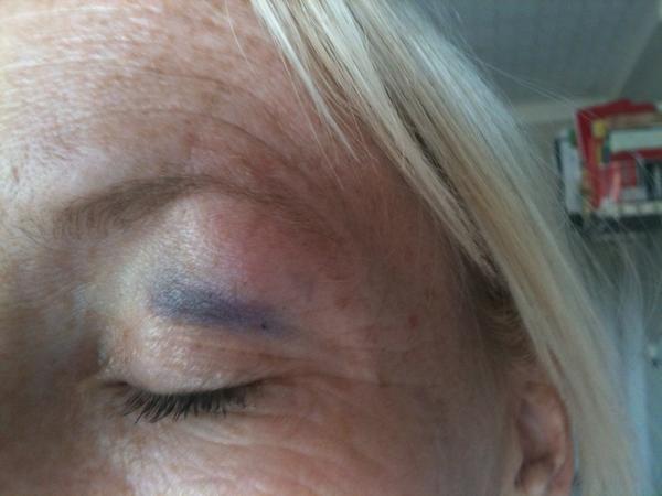 melanie_henley's tweet image. I have my first black eye courtesy oft darling daughter ! #headbut