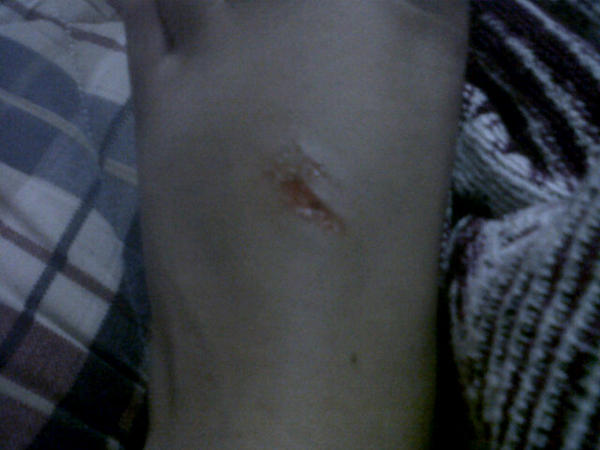 _sheimurillo's tweet photo. Una pequeña herida :'( http://t.co/2zp5SB4o