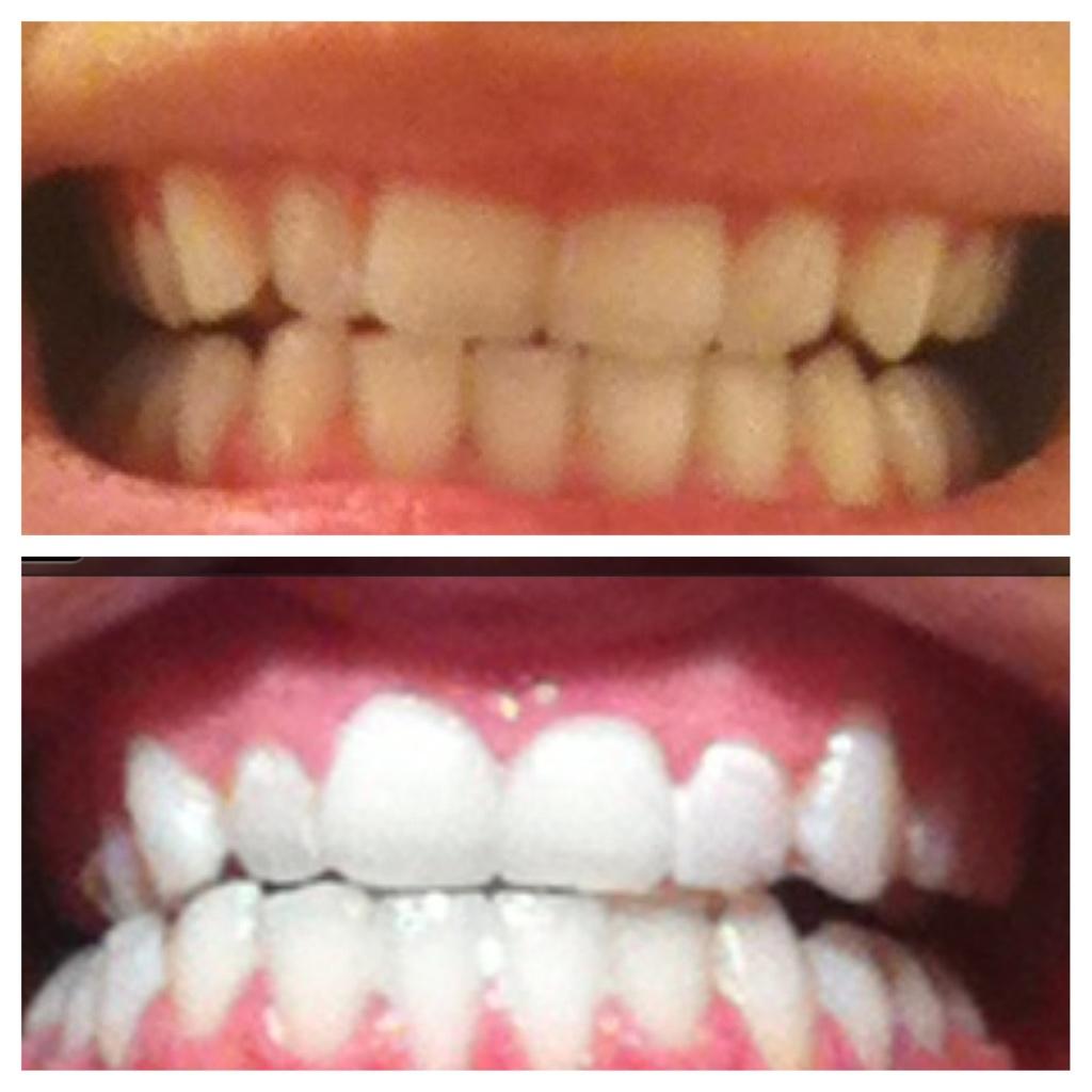 Laura Ashley on Twitter: "Laser Teeth Whitening Results in just under 1 hour!! ONLY £60!! DM or ...