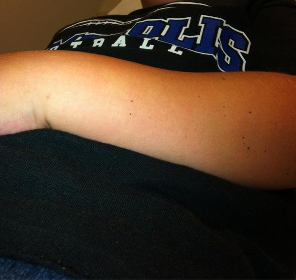 im1bigmomma's tweet image. At the Whit! #ER #brokearm #poorbaby