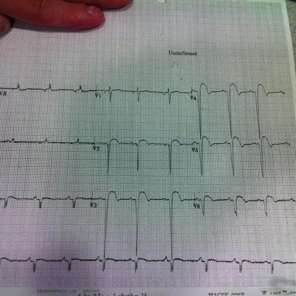 This is what a heart attack looks like on an ECG. Don't delay if u have chest pain! #MRIED 
<a href="/theBHF/">British Heart Foundation</a>