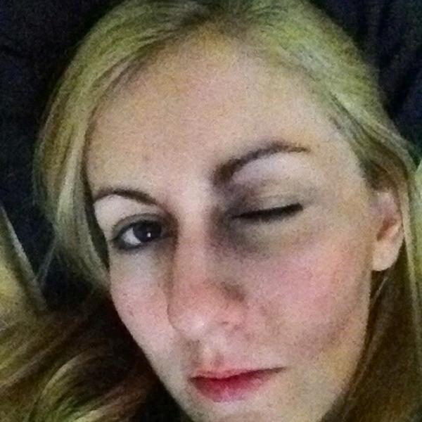 OliveSwift's tweet photo. @mrshomer_s @officialnetsua @kb0re here is a photo of the injuries I sustained last night. Shame on @ByoLogyc http://t.co/k5rLYtjx