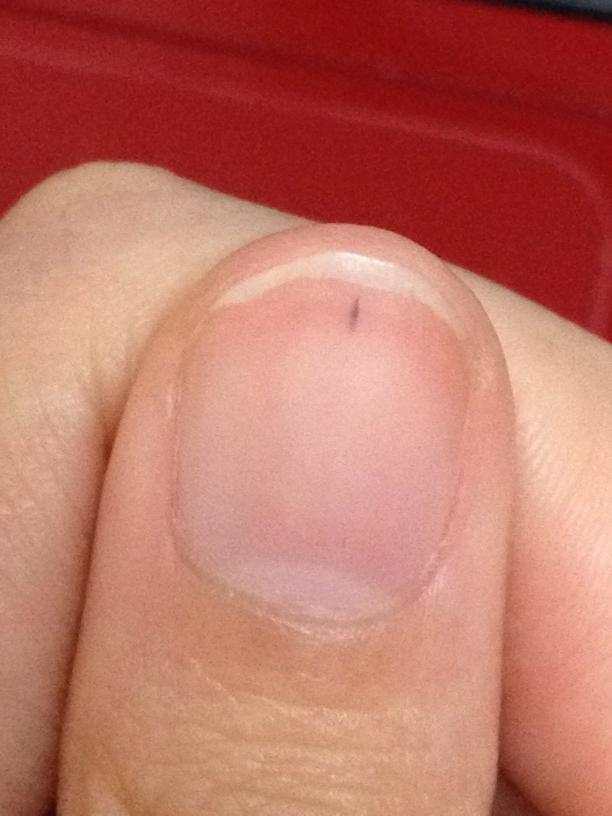 あ 手の親指にほくろできたんだけど大丈夫かこれ ˡ Http T Co 9bjqmeec Twitter