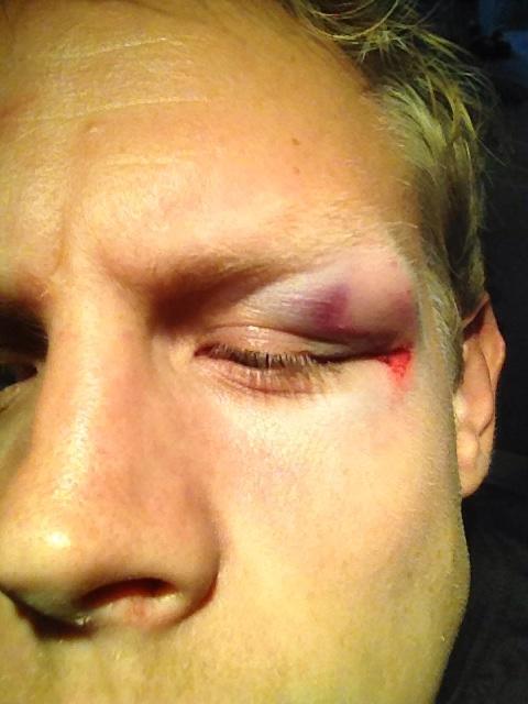 teejacob's tweet photo. Suggestions as to what to do with this bad boy? Ice it? Drain it? http://t.co/G2hwYqlA