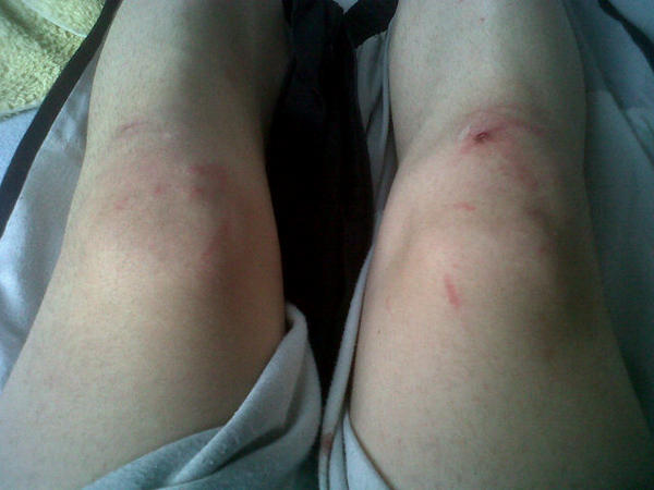 DaveMont's tweet image. And I wonder why my knees are forever sore.. #everyrace #mustlearnhowtoridebicycle