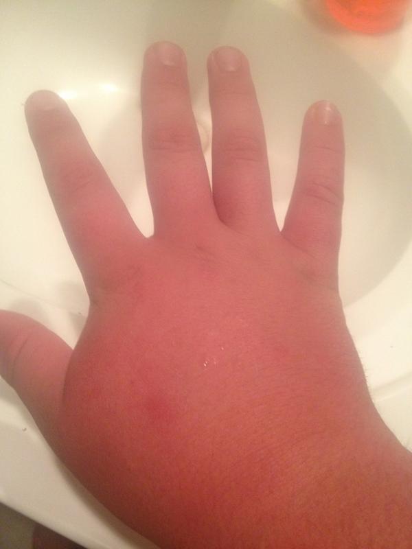 ParkerPedigo65's tweet image. @CenterProbs when your hand gets nice an swollen