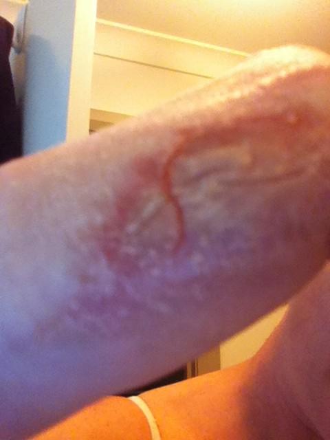 Mezzie_A's tweet photo. The blister just popped! Ouchies 😪 http://t.co/kKaYudjn