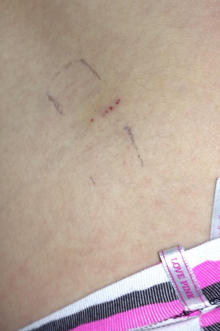Small but dangerous! (My 6 lined up lumbar punctures...) OWW.