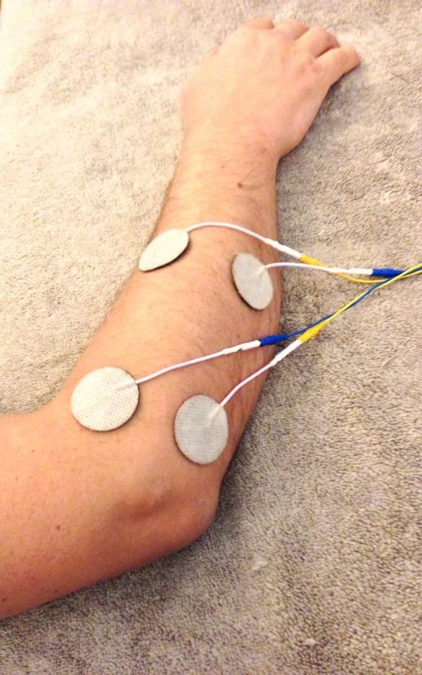 HullTherapies's tweet image. #tennis_elbow initial treatment - #interferential 1-5 Hz 10mins prior to #heat_treatment #vibration_massage #kinesio