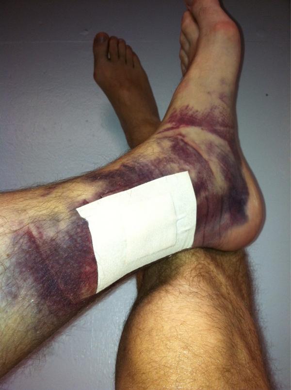 RealCJ10's tweet photo. Y'all remember that line drive from Bj Upton I took off the ankle this year? Be glad I left the bandage on!!! Yuck! http://t.co/1REXSSDn
