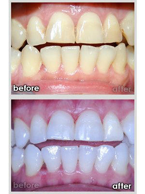 StudiobBanus's tweet photo. Teeth Whitening at Studio B Banus 99 Eoros for 45 minutes of treatment. Excellent results http://t.co/0yS7XXcp