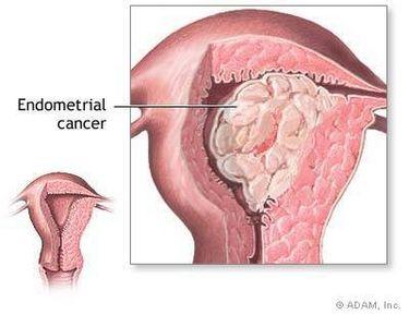 LifeUninterrupt's tweet image. Across the world, around 50–75% of women have suffered from uterine fibroids @DailyFitnessTip life-uninterrupted.com