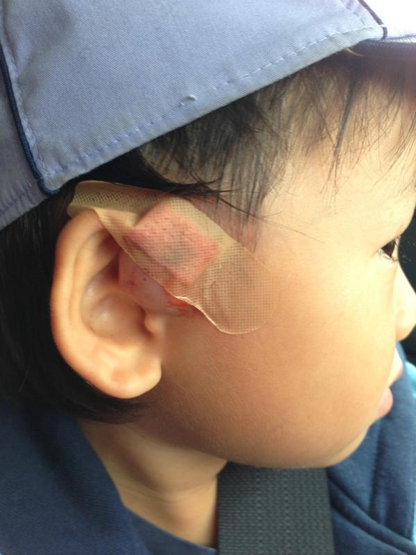 四宮琴絵 ジョイゾーcooとhokkaido Design Code代表 とうとう息子の耳ろう孔が破裂したので 病院へ 注射で膿を出して処置したけど 痛そうだった T T 手術も必要だと言われたし 当面は炎症を抑えたりしなければいけないらしく 痛い処置を続けなきゃ