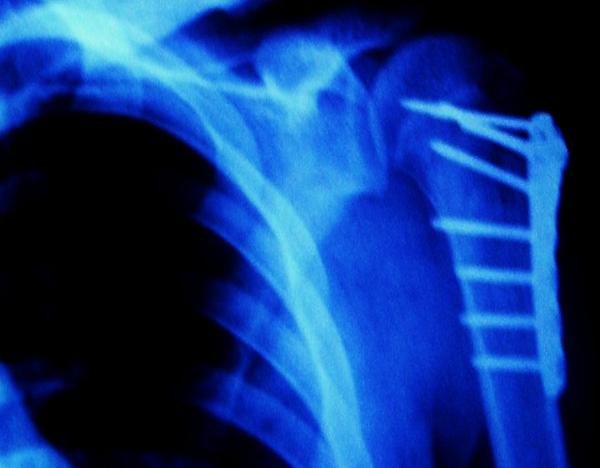 Freestyleandrew's tweet image. This is whats in my shoulder.... #TheBionicMan