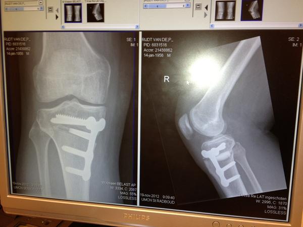 paultje56's tweet photo. Nog 6 weken em dan weer normaal ???? http://t.co/rWHVQ2zz