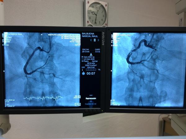 drestradaalfred's tweet photo. El caso de hoy 100% éxitoso!!! Angina post infarto coronaria derecha #InstitutoCardiovascularTuxtla @cardiotel 6025949 http://t.co/XS2zUnTf