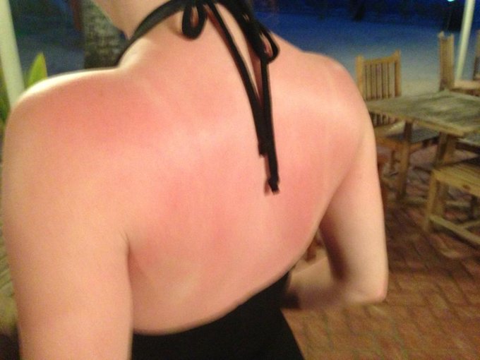 Despite my best efforts I got totally burnt. My skin was just not made for sun exposure. http://t.co<a href="/tag/sinicaltopaltmodelpoll"class="tags"><span>#sinicaltopaltmodelpoll</span></a>