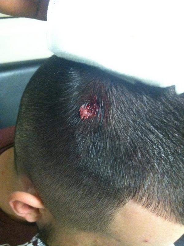 Chase with a hole in his head!!