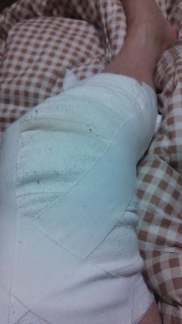 ゆでたまご嶋田 火傷はこんな状態です 中井がようやく復帰したばかりだというのに 今度は私が 仕事はできるだけ休載しないように頑張ります キン肉マン Http T Co Ng15osyu ゆでたまご嶋田 火傷はこんな状態です 中井がようやく復帰したばかりだというのに 今度は私が 仕事はできるだけ休載しないように頑張ります キン肉マン Http T Co Ng15osyu