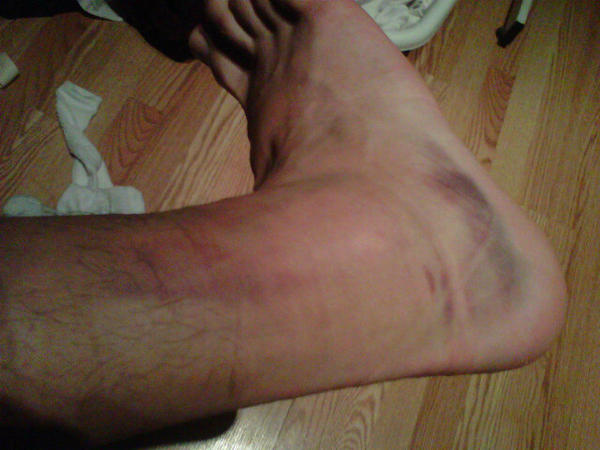 KlevlinCutknife's tweet photo. Broken Ankles! #HighSchoolBasketball http://t.co/Rhw7p1Aw