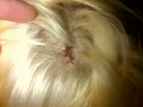 jolene1709's tweet photo. My head after my operation http://t.co/0WrEHhDo