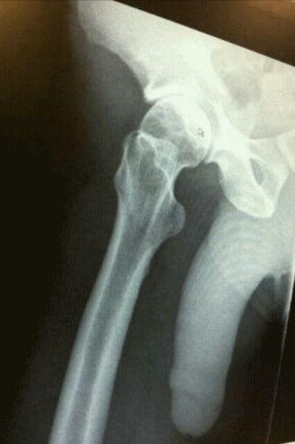 MRJSRT's tweet photo. Just been for an xray, think I may have broken my leg ;( http://t.co/qEa2k7JW
