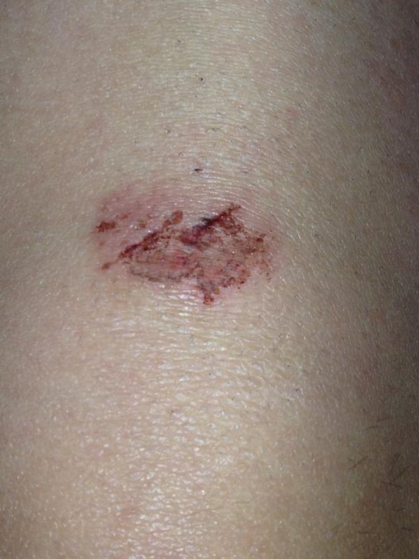 daryl_pattie's tweet image. gonna look so good on Xmas nights out sporting this bad boy #hateice #whenssummer