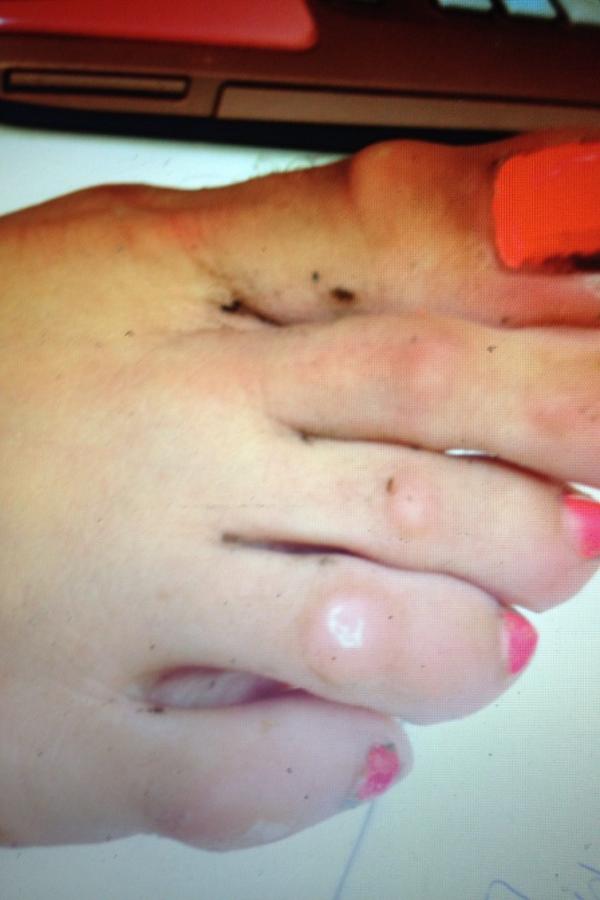 CloggerProbz's tweet photo. This is what happens when you clog without socks. #cloggerproblems http://t.co/F3TWxAtt