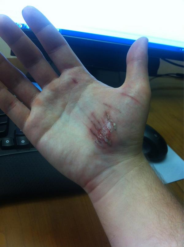 There goes my promising hand model career.