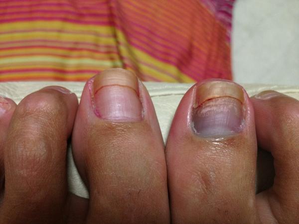 Leina 二枚爪も治る前に右の親指の爪がテニス中に死亡 Http T Co Rs3wno3k