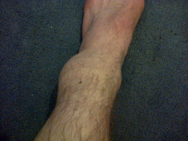 yourboyygc's tweet image. My ankle is looking great loool #Sprained #NotBroken