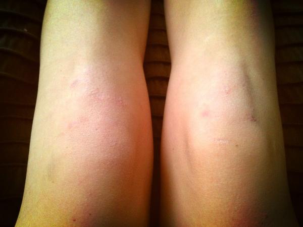 TrackieLife's tweet image. #HurdleProbs scars on scars on scars #TrackieLife