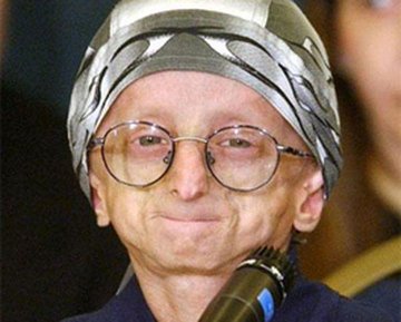 Progeria Malattia Genetica