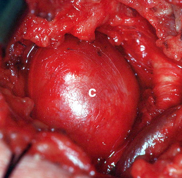 Cerebellar pilocytic astrocytoma...  
cancercure-d.blogspot.com/2012/03/differ… 
radiopaedia.org/articles/piloc… 

#BrainTumorThursday