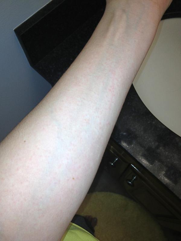 stuunalee's tweet image. Breaking out again..
NOOOOOOOOO
#allergicreaction
#towhat?
#IHAVENOIDEA